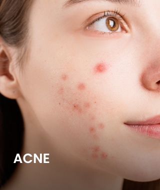 Tratamento para acne.