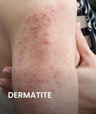 Dermatite.