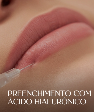 Preenchimento com ácido hialurônico.