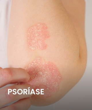 Psoríase.