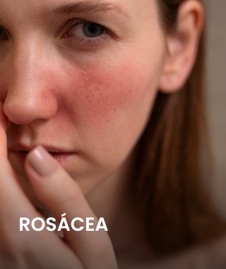 Rosácea.