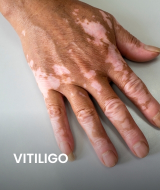 Vitiligo.